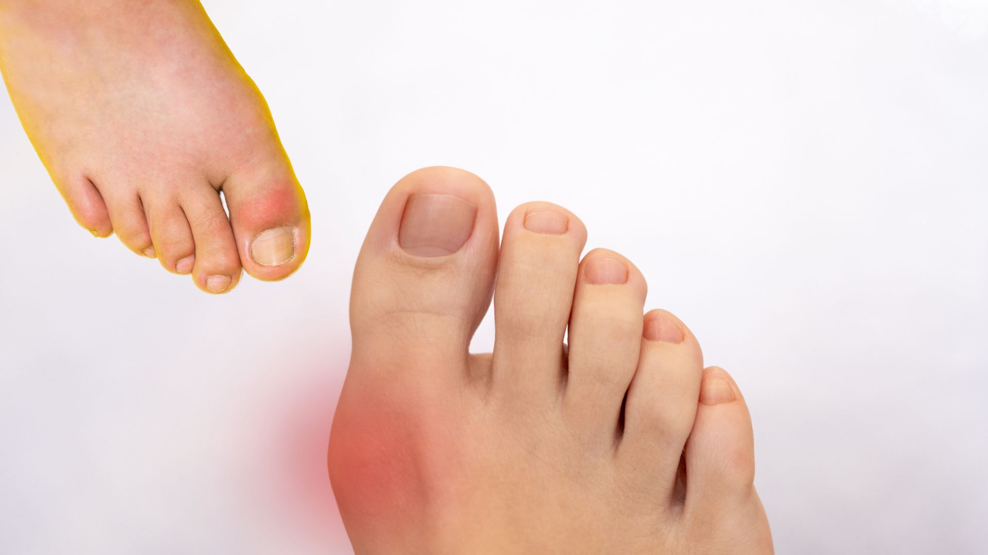 According to experts, increased uric acid in the blood is only the most important risk factor for gout, but not everyone with high uric acid will have arthritis attacks. Use of AI: Huong Son