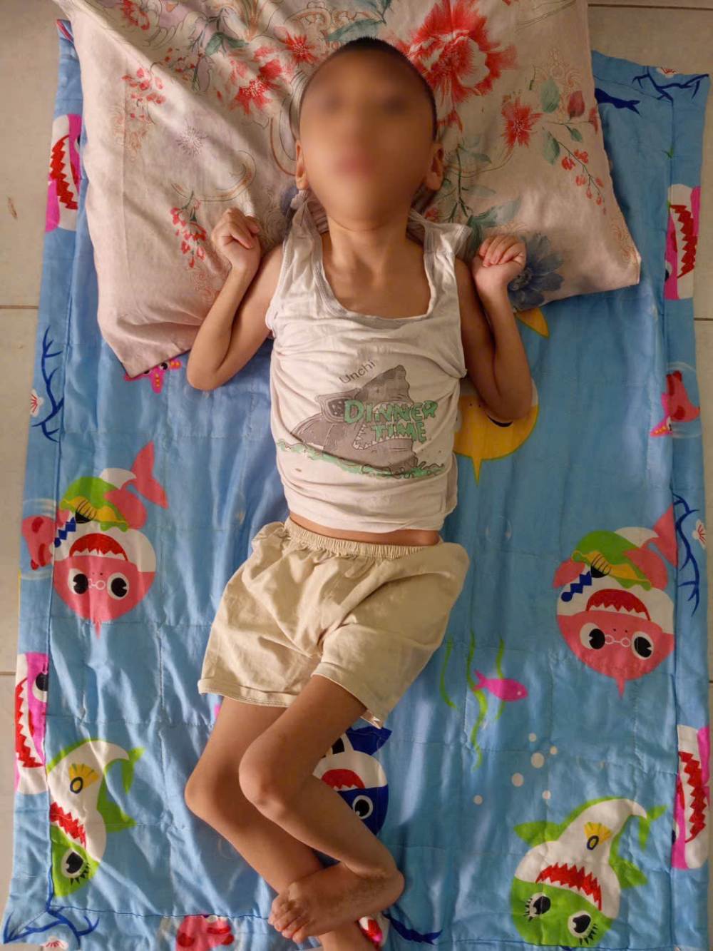 Bé Khải Tâm mắc bại não, động kinh và tật đầu nhỏ bẩm sinh. Ảnh: Gia đình cung cấp