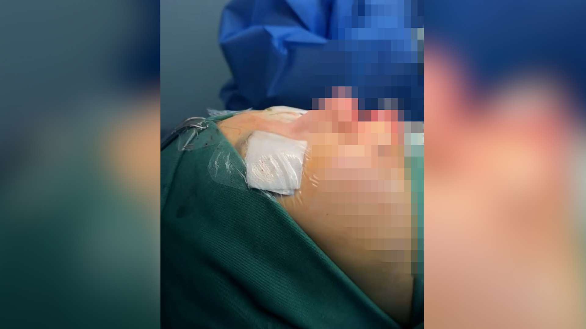 Chị Nhật Linh được tư vấn thực hiện nâng mũi bằng sụn tự thân với chi phí khoảng 190 triệu đồng, cắt mắt hơn 75 triệu đồng và làm nhân trung 29 triệu đồng. Ảnh: Nhân vật cung cấp