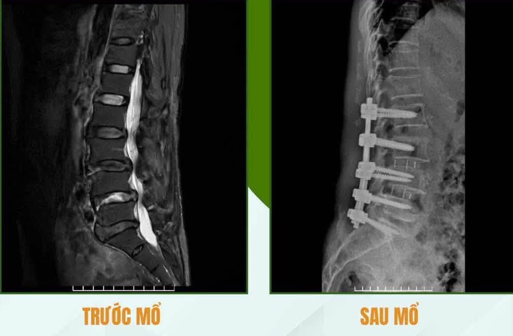 Doctors have just successfully operated on a case of multi-layered spine disease in an elderly person. Photo: Military Hospital 87