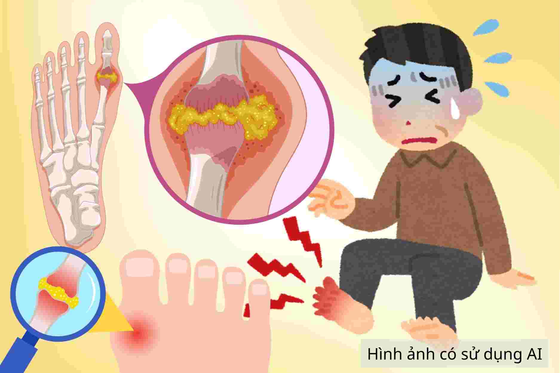 6 formas de tratar el ataque agudo de gota en casa