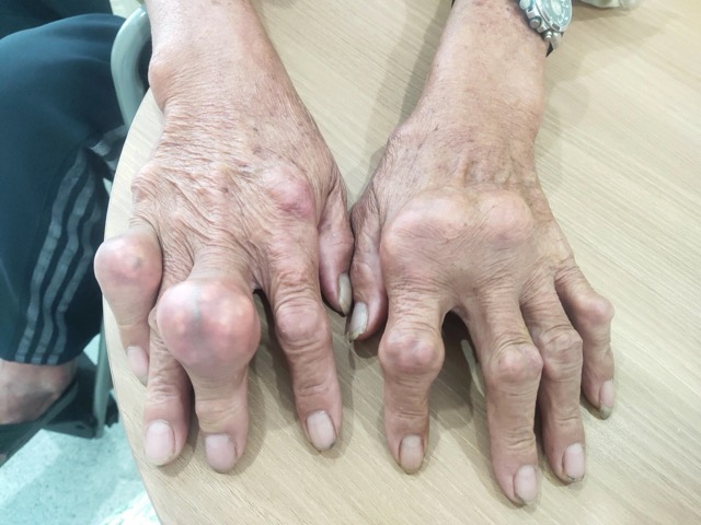 El tumor en la articulación del dedo puede formarse debido a la acumulación de cristales de ácido úrico. Foto: Hospital General Tâm Anh Distrito 7 proporcionada