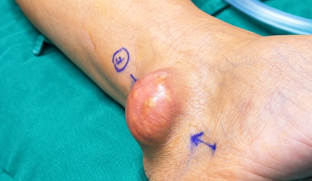 Large tophi particles appear around the joints in people with long-term gout, high uric acid levels. Photo: Minh Anh International Hospital provided