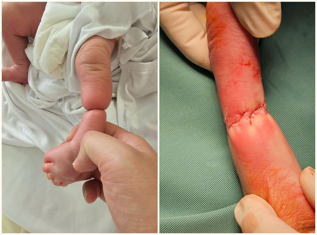 Newborn baby had surgery due to rare amniotic band syndrome. Photo: Provided by Phu Tho Provincial Obstetrics and Pediatrics Hospital