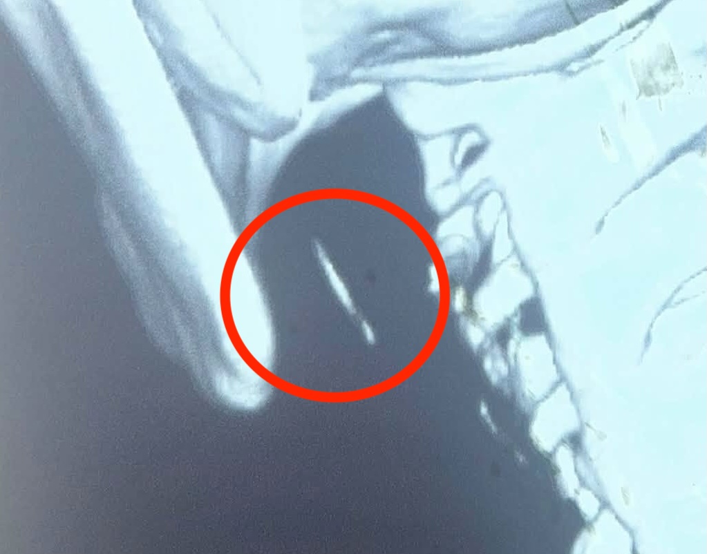 Fish bone stuck in the hypomandibular gland for 5 months. Photo: Provided by Bac Quang Tri Regional General Hospital on September 15