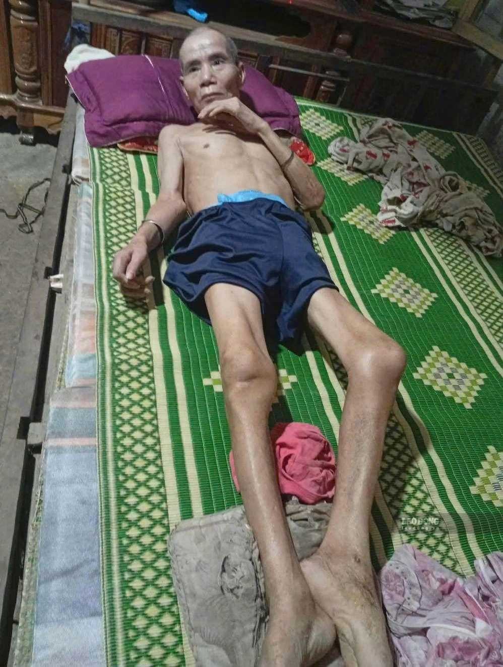 El Sr. Hoang Van Yeu está paralítico de todo el cuerpo. Foto: familia proporcionada