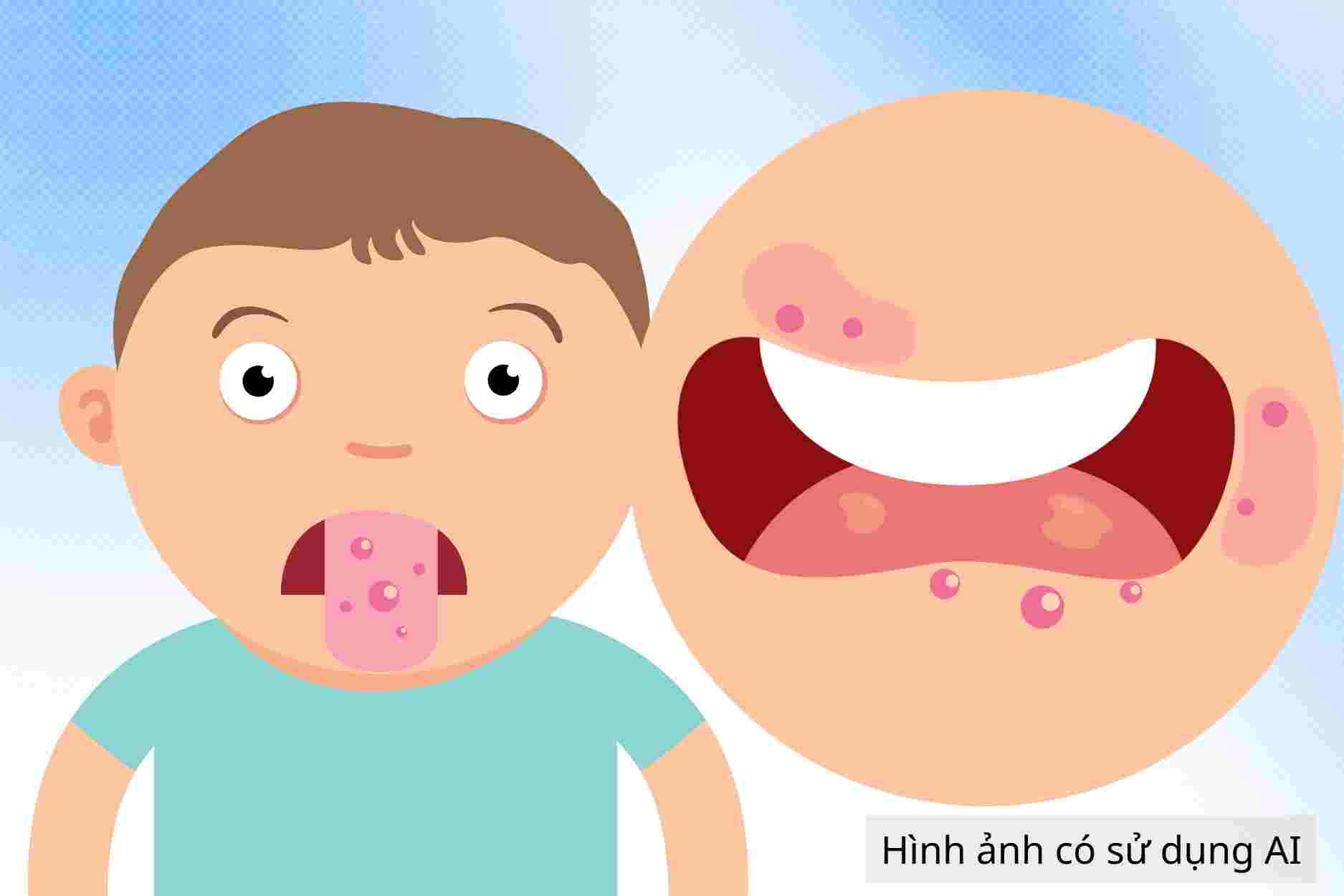 How to care for children with hand, foot and mouth disease in the tongue