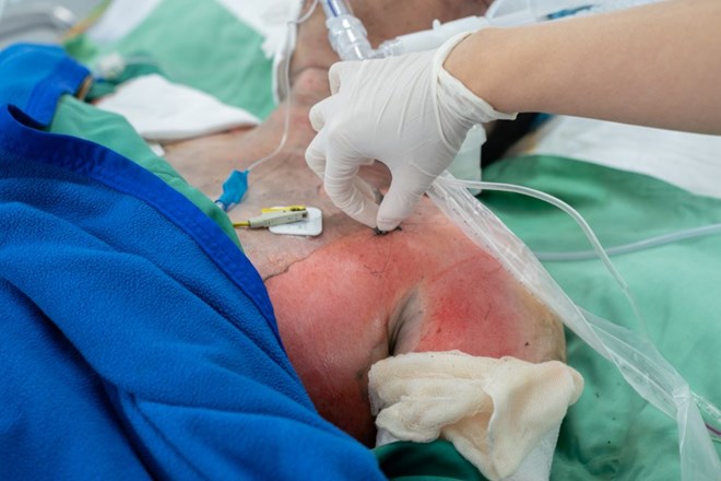 Actualmente, las víctimas del incendio de la casa están recibiendo tratamiento activo. Foto: Hospital Cho Ray proporcionada