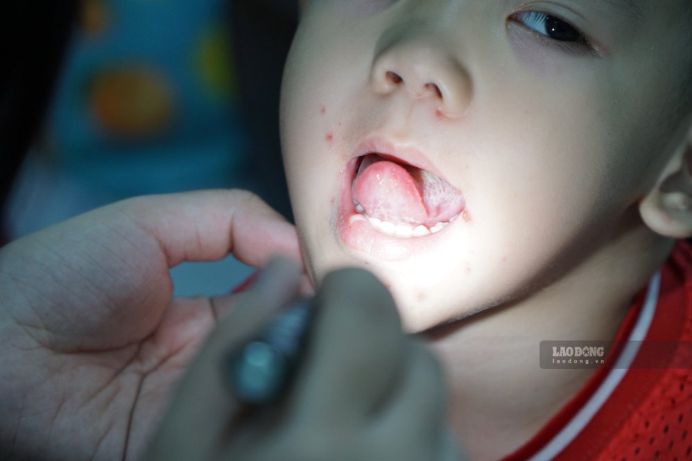 Severe hand, foot and mouth disease cases account for nearly 1/3 of inpatients at Children's Hospital 1
