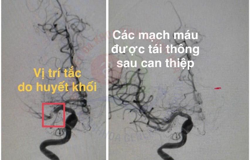 Russian tourists with a stroke are being treated by doctors using endovascular intervention techniques to suction mechanical thrombosis. Photo: Khanh Hoa General Hospital