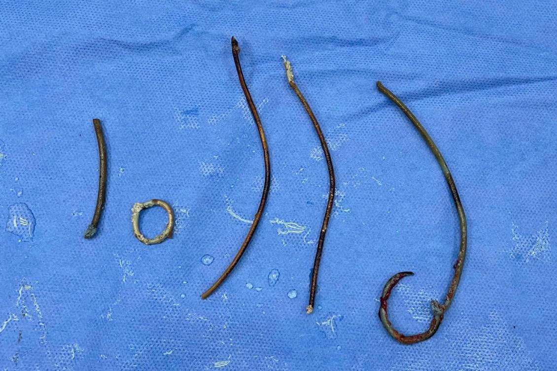 Sonde JJ – this is a flexible plastic tube, intended to help urine flow from the kidney into the bladder after surgery. Photo: hospital provided