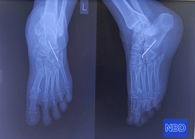 X-ray image of the patient with bone-combined screwdriver. Photo: Hoc Mon Regional General Hospital provided on September 21, 2026