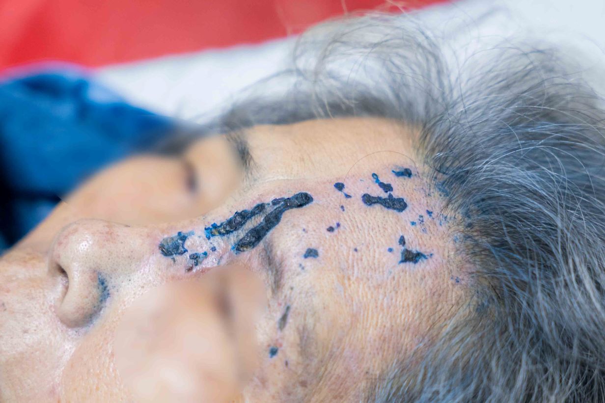 Zona in the skin area. Photo: Hospital provided