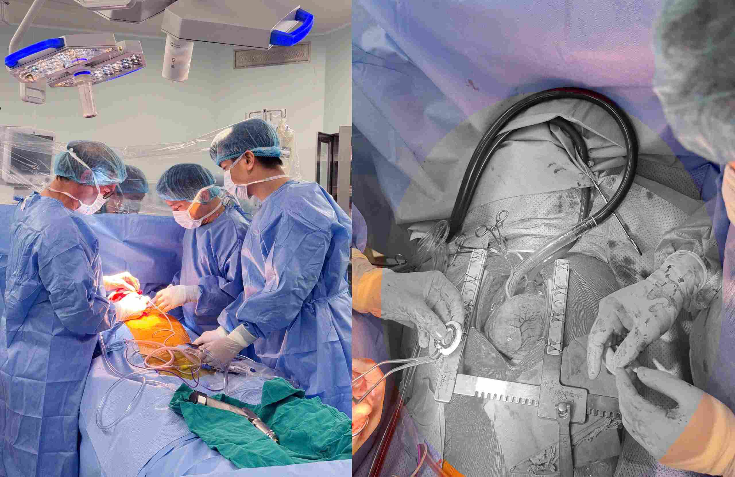Doctors perform the first CorHeart 6 transplant in Vietnam for heart failure patients. Photo: Provided by Central Military Hospital 108