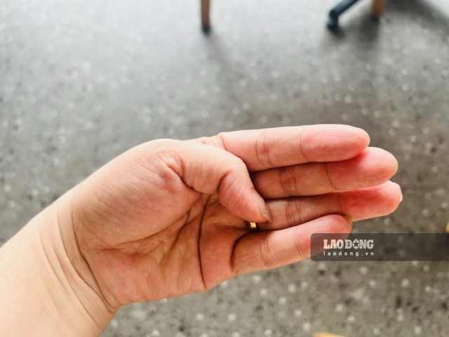 Prolonged hand numbness may be a warning sign of neurological disease. Photo: Nguyen Ly taken September 23, 2026