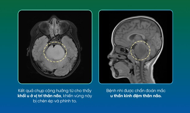 Hình ảnh chụp cộng hưởng từ (MRI) não của bé gái 7 tuổi. Ảnh: BVCC