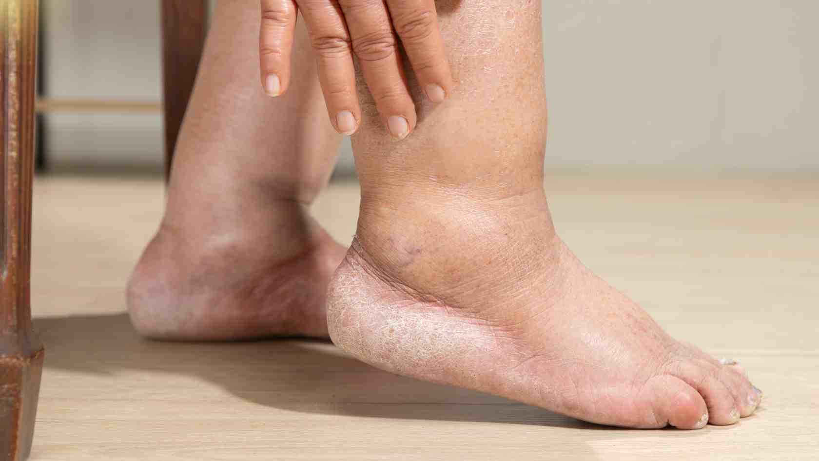 High uric acid but not yet gout, kidneys can still be affected. Photo: Minh Anh International Hospital provided
