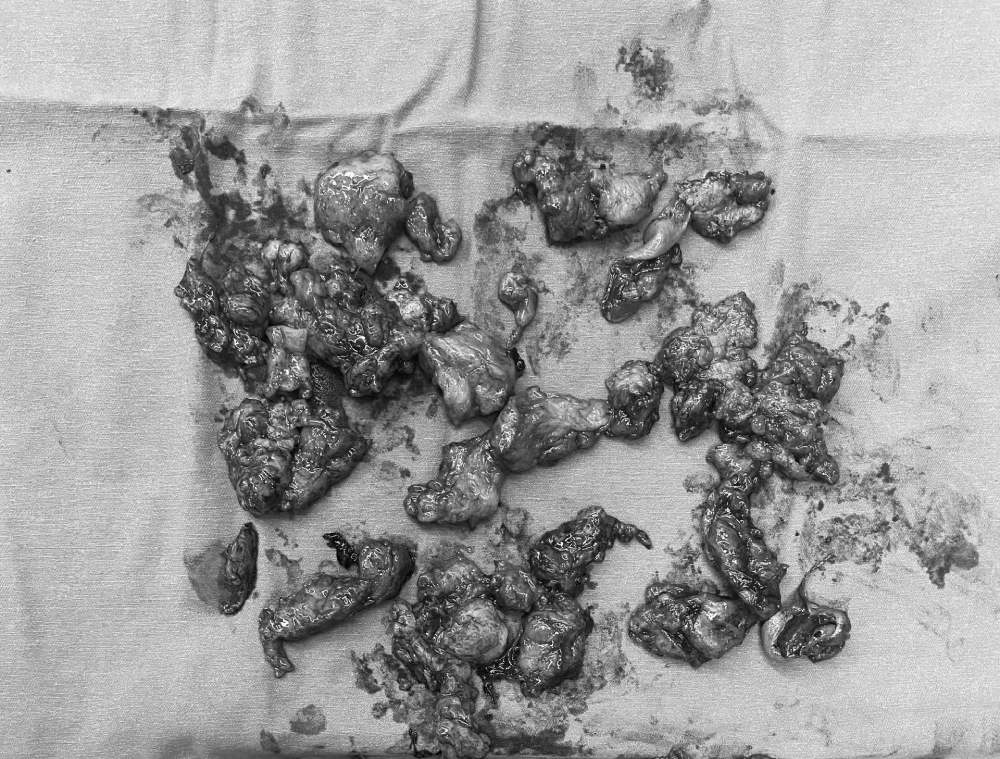 Injection Object Filler injection 10 years ago, now suddenly abscess, infection