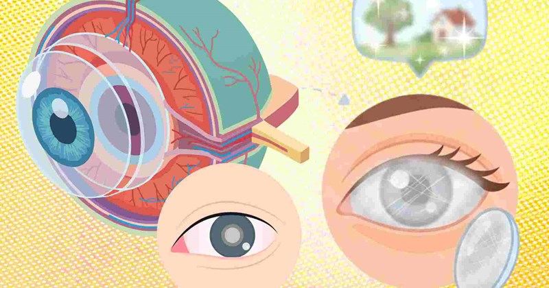 Droopy Numbers Number of times you can perform cataracts that you should know