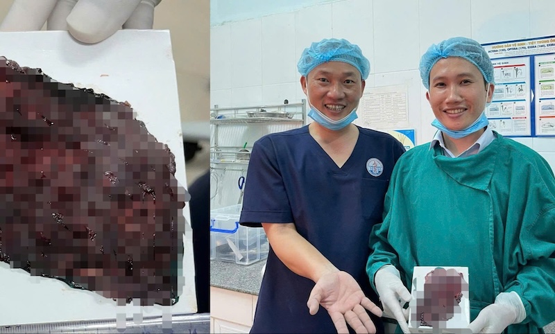 Doctors and nurses of Quang Tri Provincial General Hospital endoscopically dissect the precancerous mucosal area. Photo: Quang Tri Provincial General Hospital