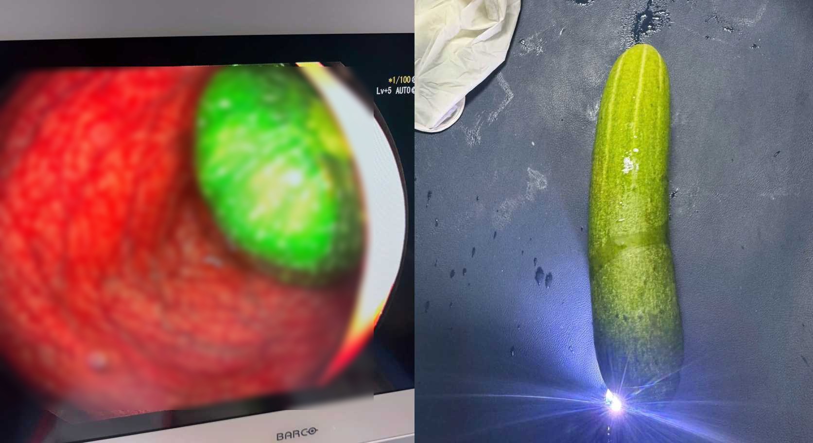 El cuerpo extraño es un pepino de 20 cm de largo que los médicos y enfermeras endoscópicos extrajeron del recto del paciente. Foto: Page Hospital General de Bac Ninh No. 1