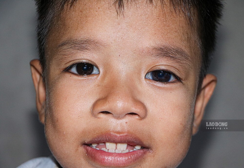 Quy Duong - a 5th grade student with a disability in his eyes, one left eye cannot see the road. Photo: Nguyen Luan