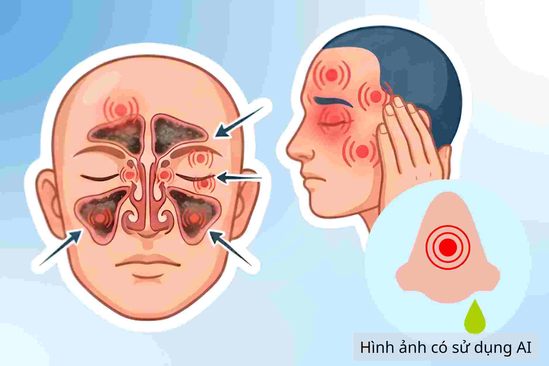 Signs of headache, nasal congestion due to sinusitis