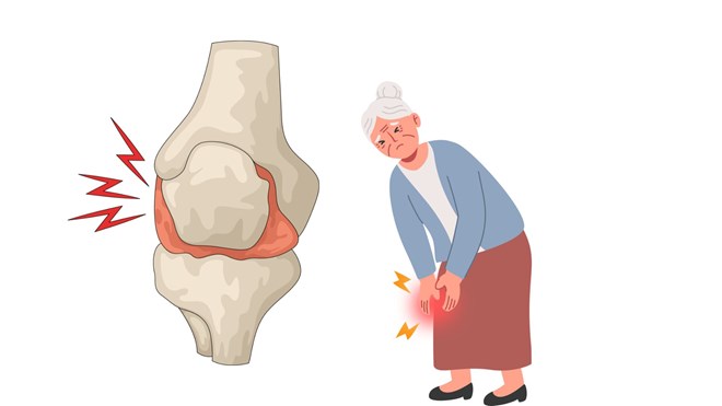 El sobrepeso también es una de las principales causas que empeoran la osteoartritis de rodilla. Foto gráfica: Hương Sơn/Con el uso de IA