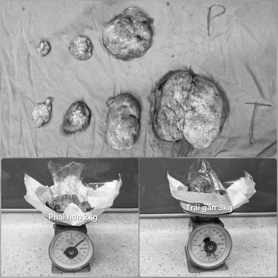 Fibroma removed from the chest of a 20-year-old girl. Photo: Bach Mai Hospital provided