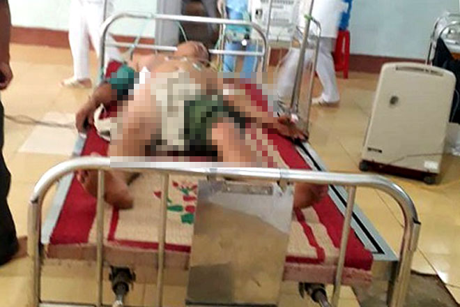 Điện giật khiến anh Chính bị bỏng nặng.