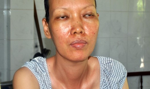 Chị Nguyễn Thị Song Bình đã hồi phục sau 13 lần hóa trị, 10 lần xạ trị