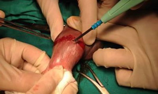 Hình ảnh phẫu thuật "sửa" lại dương vật bị gãy cho bệnh nhân (Ảnh: BSCC)