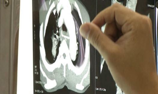 Hình ảnh hóc xương gà trên phim chụp X quang.