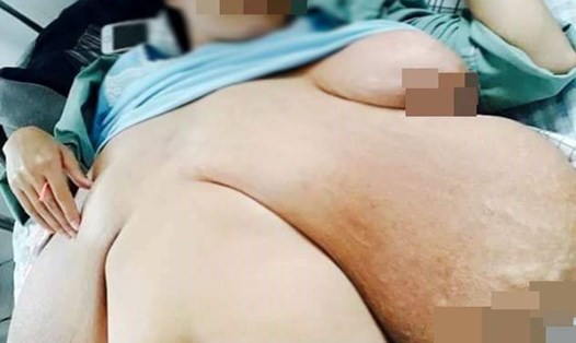 Hình ảnh bộ ngực khổng lồ trước khi phẫu thuật (Ảnh: Internet).