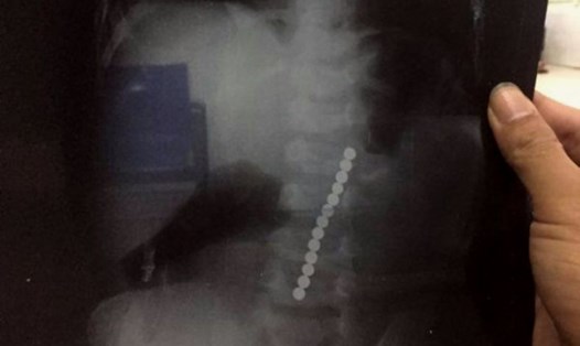 Hình ảnh 13 viên bi trong dạ dày cháu bé trên phim chụp X-quang (Ảnh: BVĐK Đô Lương, Nghệ An)