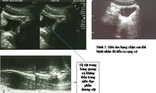 Hình ảnh dị vật trong đường tiểu của bệnh nhân (ảnh BV)