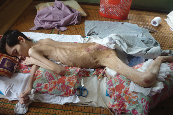 Căn bệnh u tủy sống đang hủy hoại cơ thể Nga từng ngày.