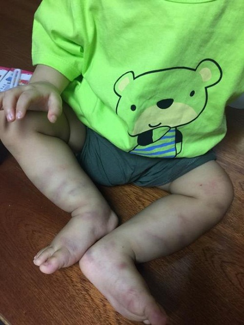 Chân bé nhiều vết tím nghi do bạo hành. Ảnh: LP