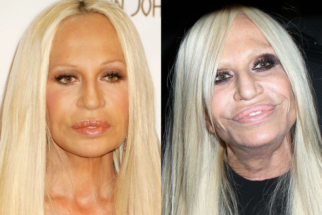 Donatella Versace là một trong những ví dụ điển hình của việc biến dạng vì sửa sang nhan sắc quá đà